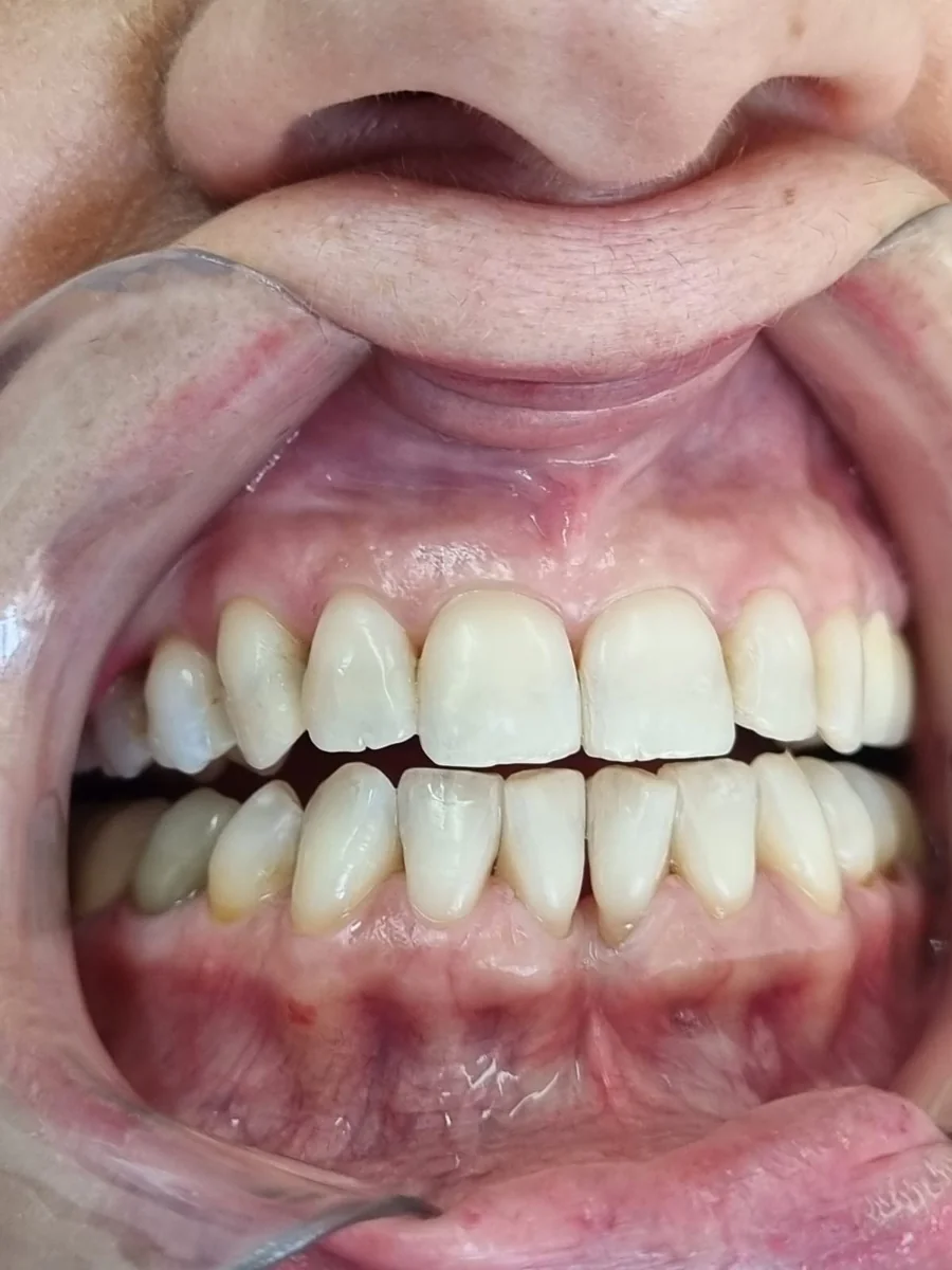 Depois — Clareamento dental