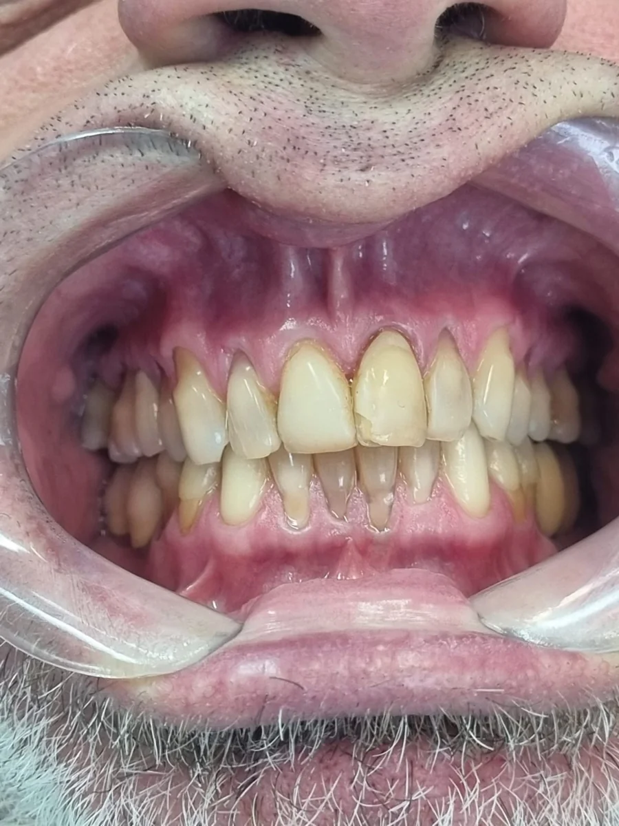 Antes — Reabilitação estética